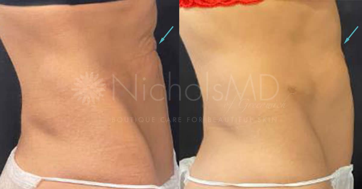 NicholsMD of Greenwich Sculptra Treatment