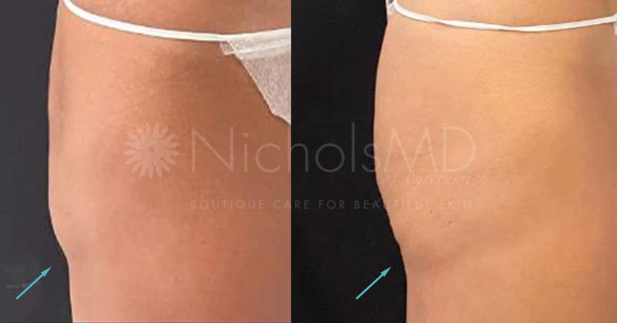 NicholsMD of Greenwich Sculptra Treatment