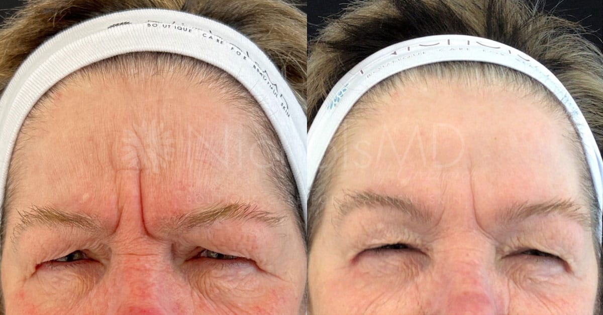 NicholsMD of Greenwich Botox® Treatment