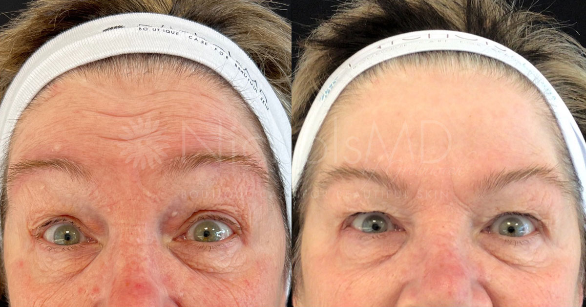 NicholsMD of Greenwich Botox® Treatment