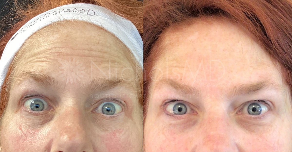 NicholsMD of Greenwich Botox® Treatment