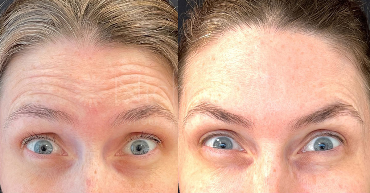 NicholsMD of Greenwich Botox® Treatment