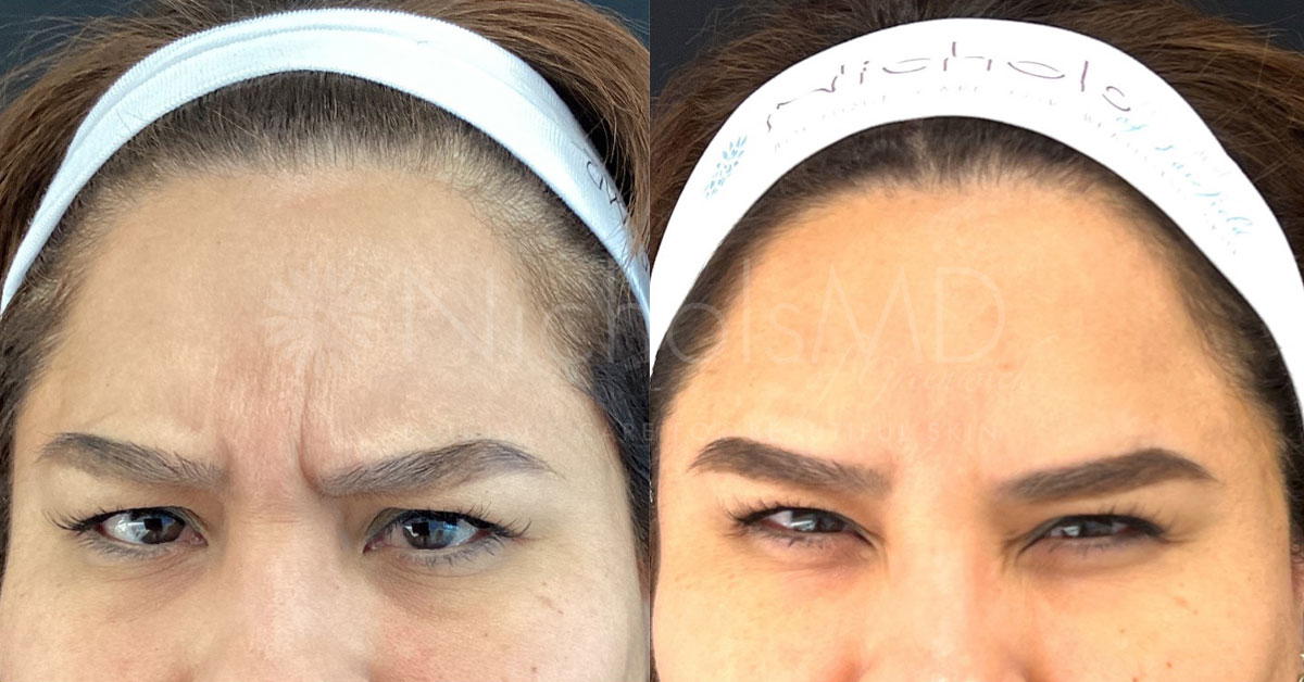 NicholsMD of Greenwich Botox® Treatment