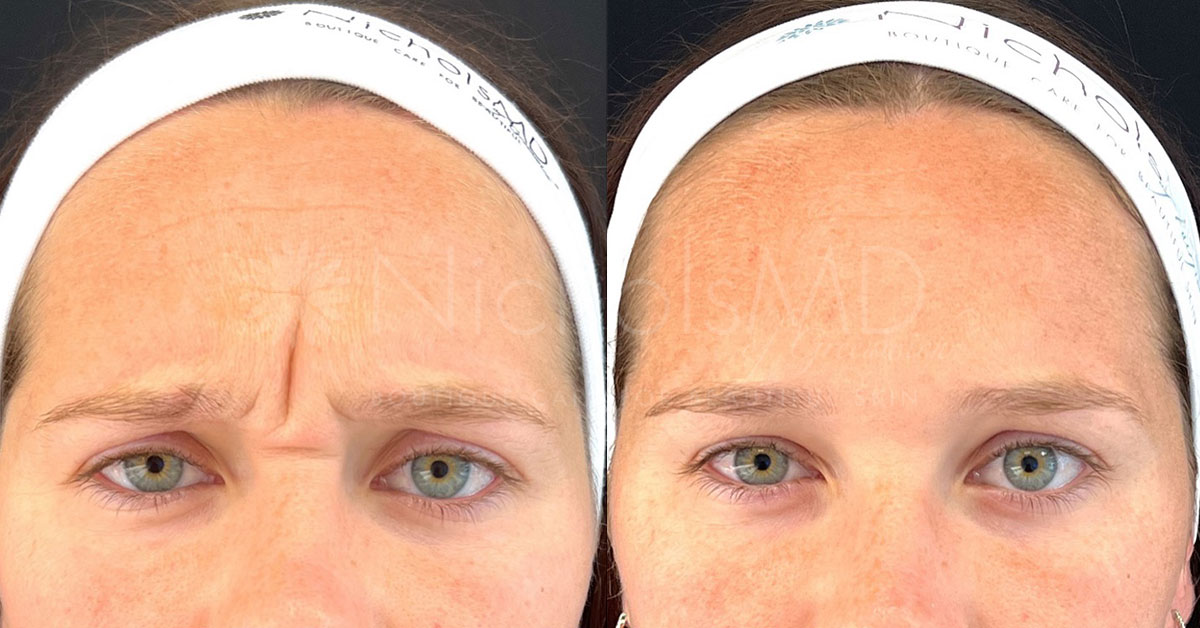 NicholsMD of Greenwich Botox® Treatment
