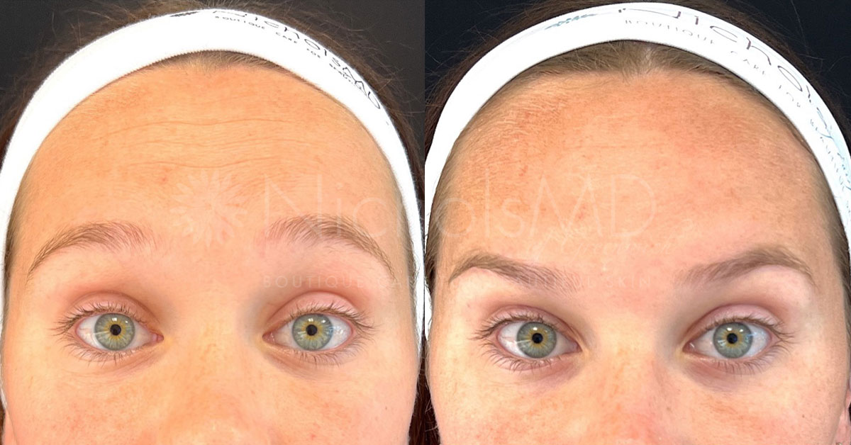 NicholsMD of Greenwich Botox® Treatment