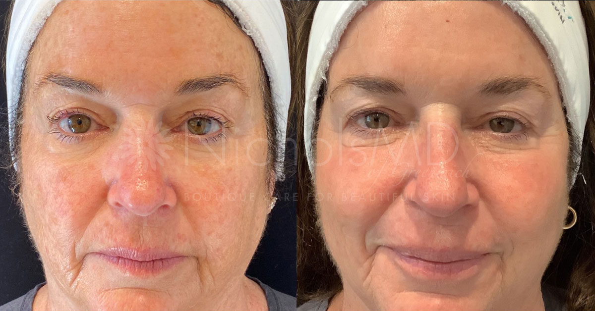 NicholsMD of Greenwich Fraxel Treatment