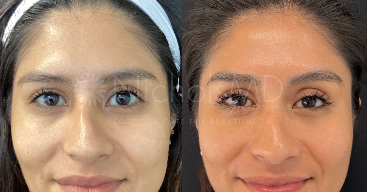 NicholsMD of Greenwich Greenwich Secret Under Eye Treatment