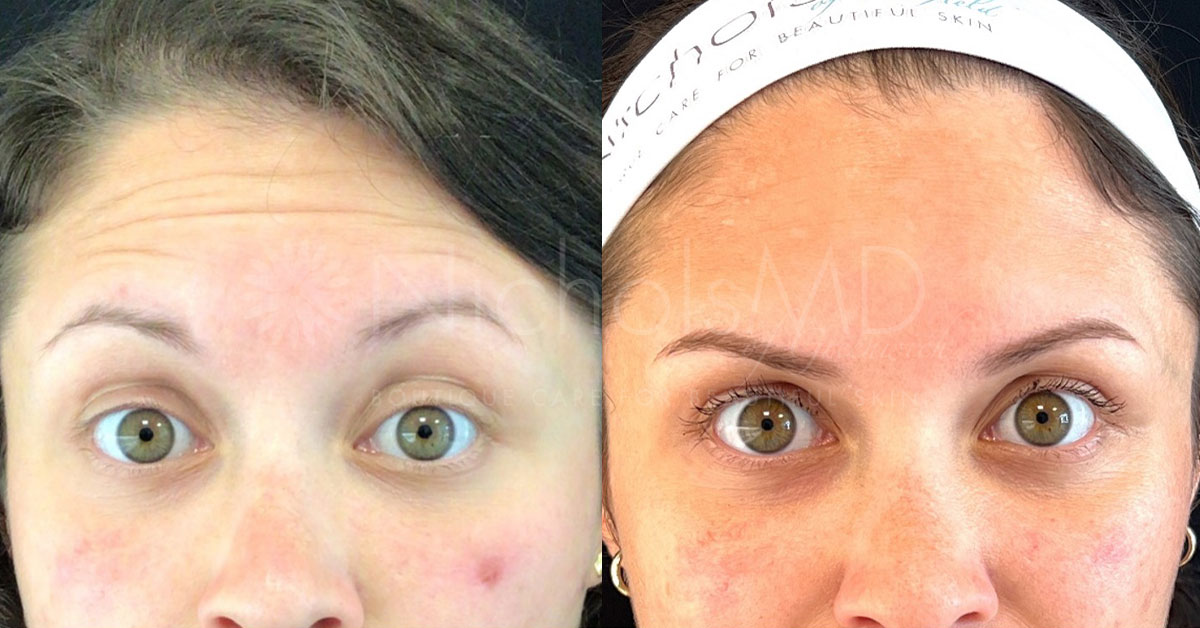 NicholsMD of Greenwich Dysport Brow Treatment
