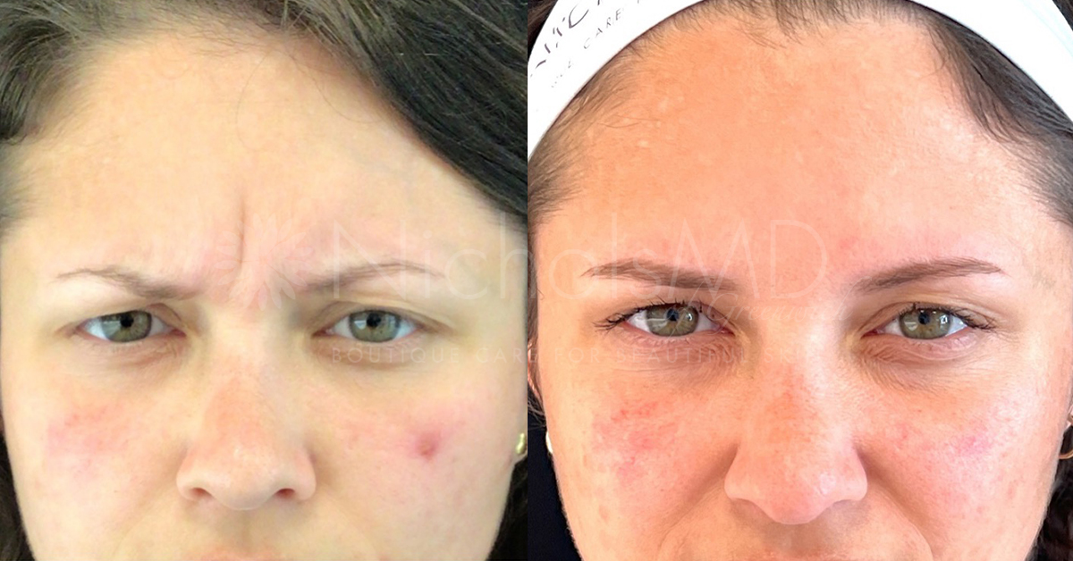 NicholsMD of Greenwich Dysport Brow Treatment