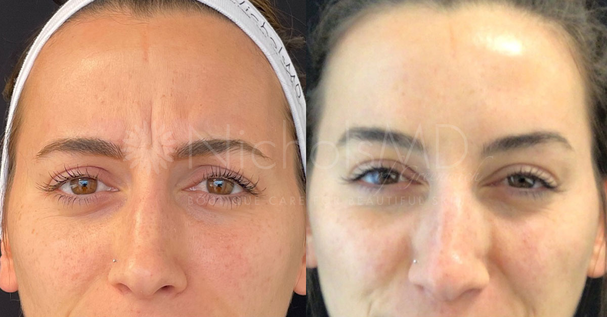 NicholsMD of Greenwich Dysport Brow Treatment