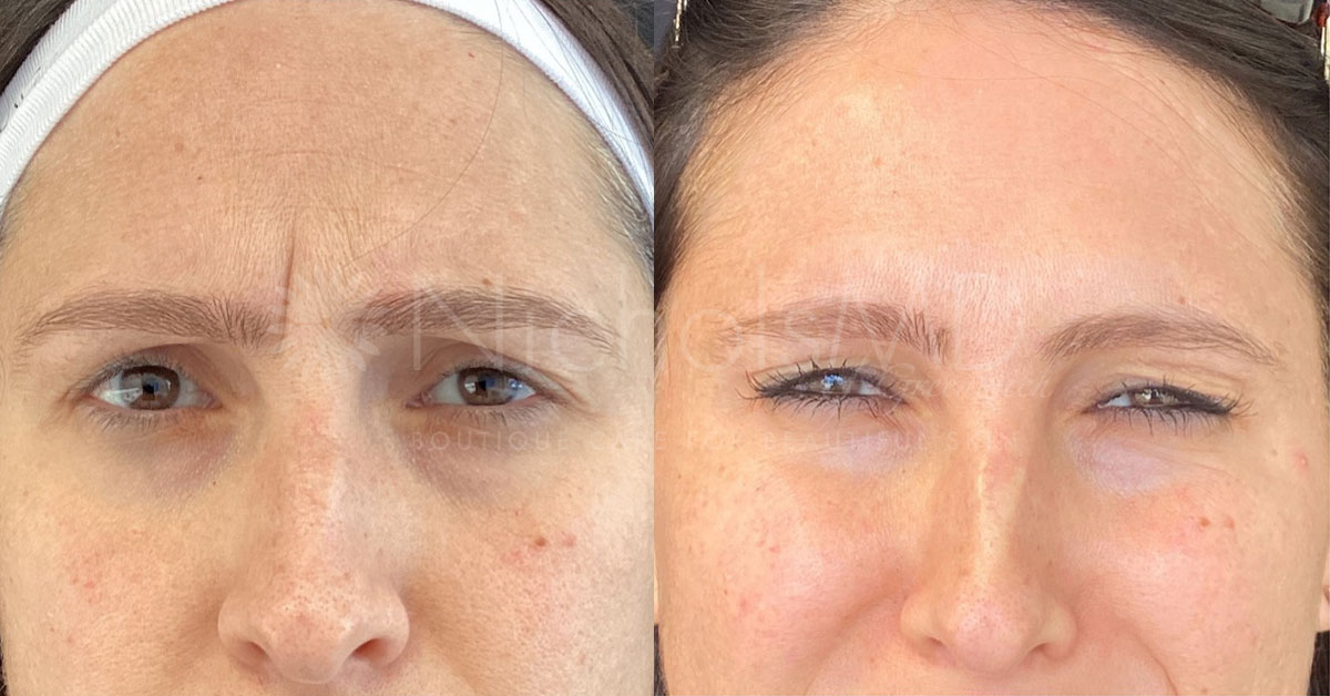 NicholsMD of Greenwich Botox® Treatment