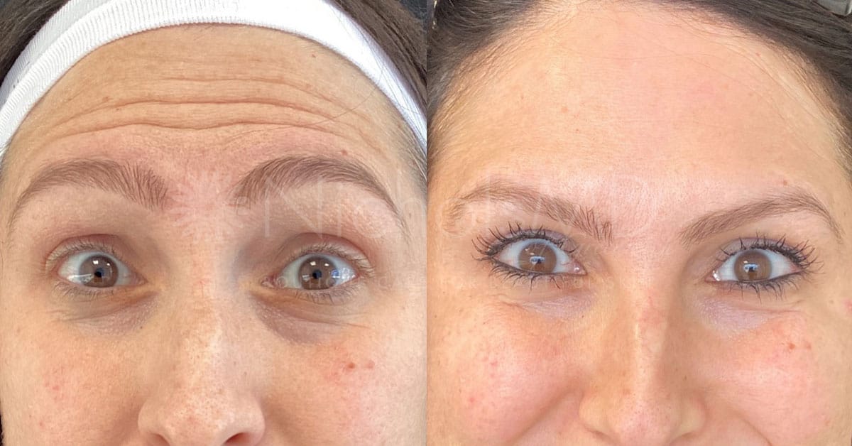 NicholsMD of Greenwich Botox® Treatment