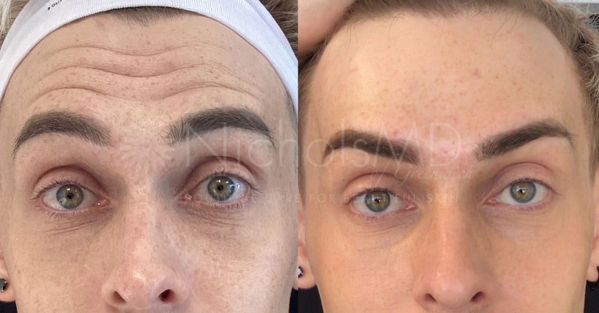 NicholsMD of Greenwich Botox® Treatment