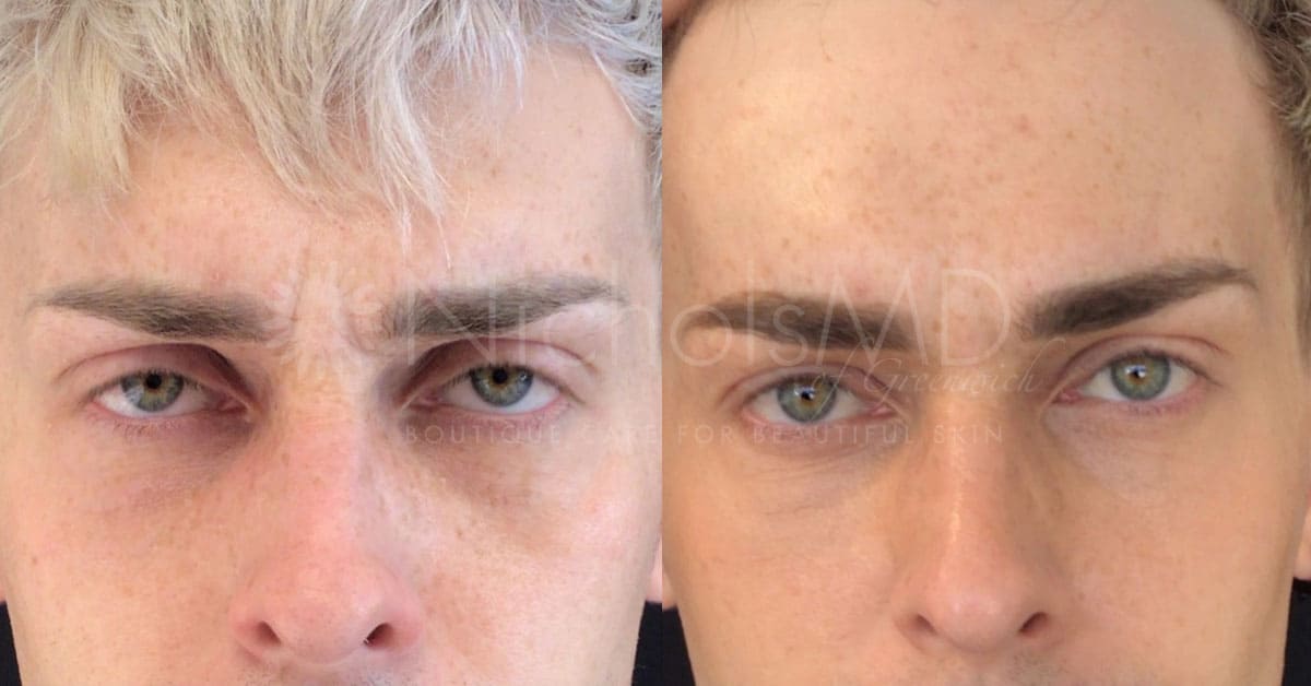 NicholsMD of Greenwich Botox® Treatment