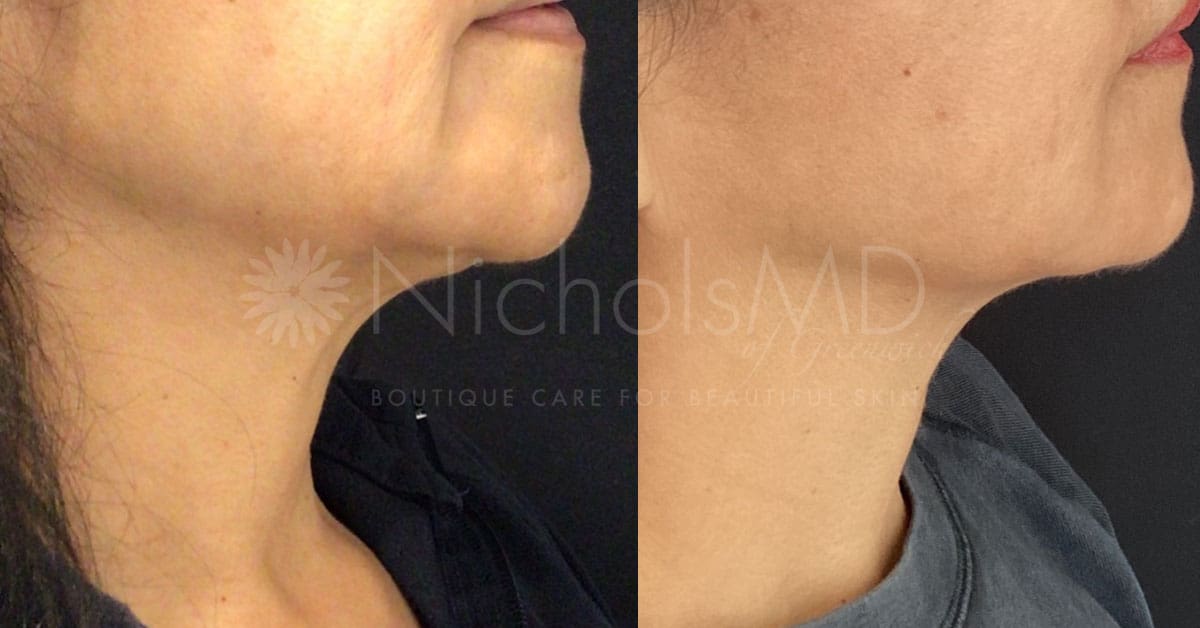 NicholsMD of Greenwich Greenwich Secret Under Eye Treatment