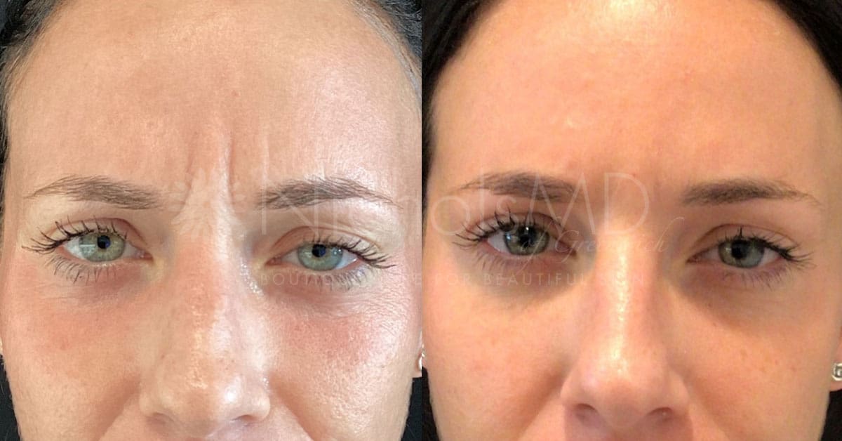 NicholsMD of Greenwich Dysport Brow Treatment