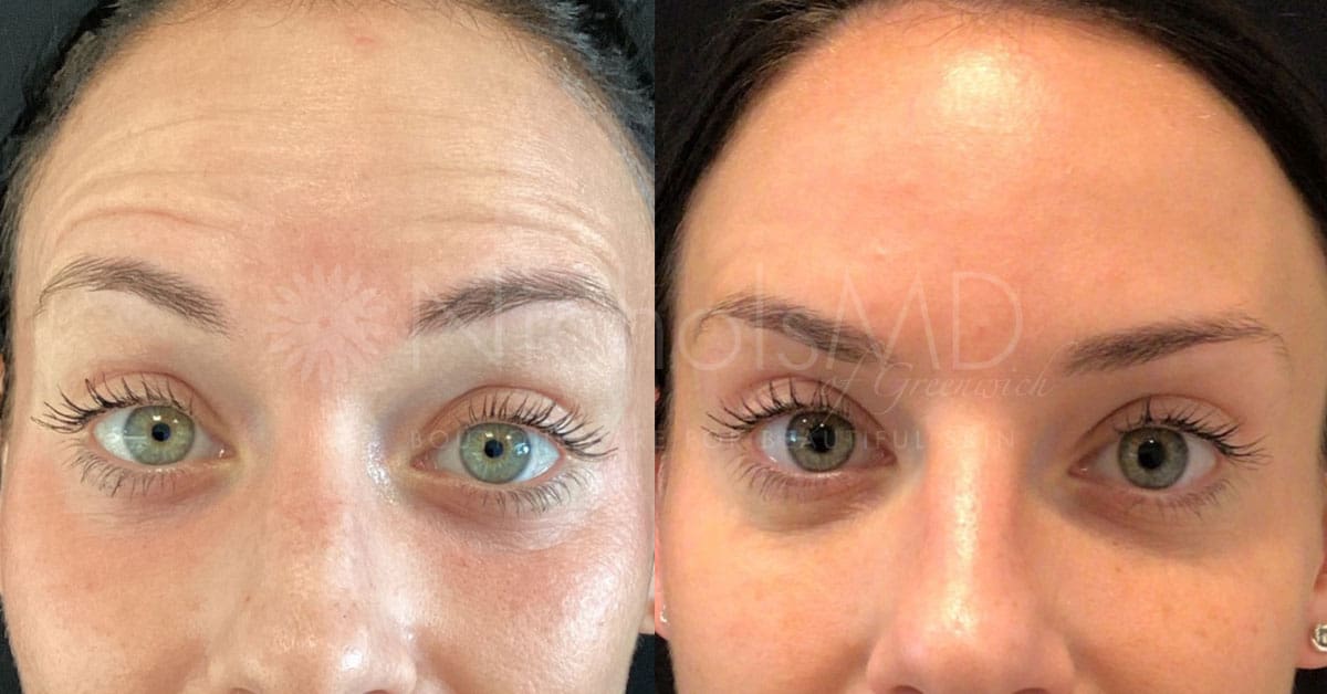 NicholsMD of Greenwich Dysport Brow Treatment