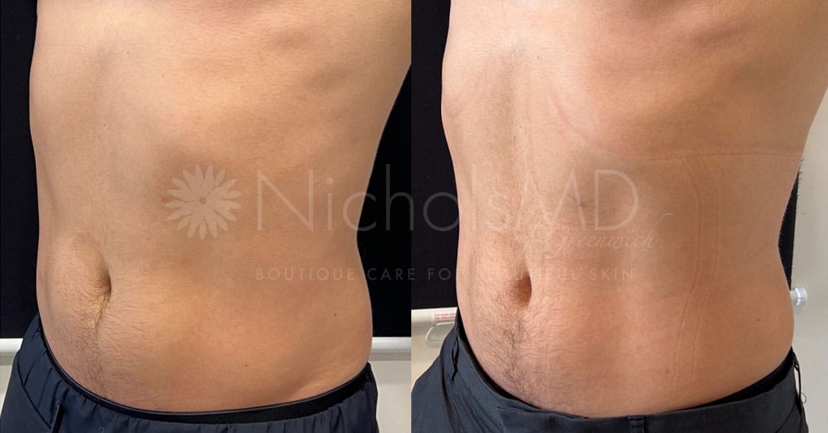 NicholsMD of Greenwich Emsculpt Treatment