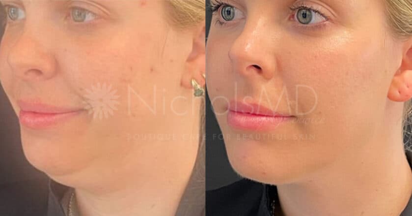 NicholsMD of Greenwich Under-Chin Fat Reduction With Kybella Treatment
