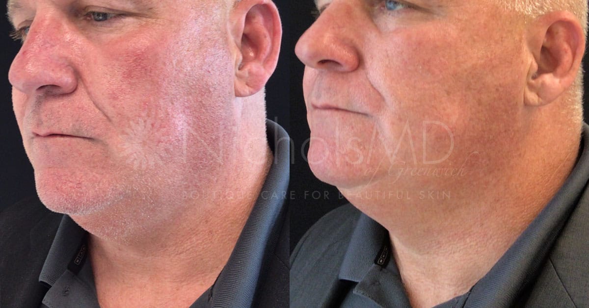 NicholsMD of Greenwich Redness Minimizing Laser 1 Treatment