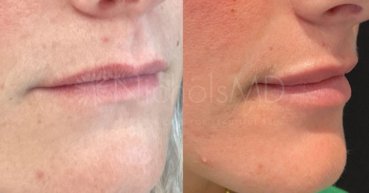 NicholsMD of Greenwich Liquid Lip Lift Treatment