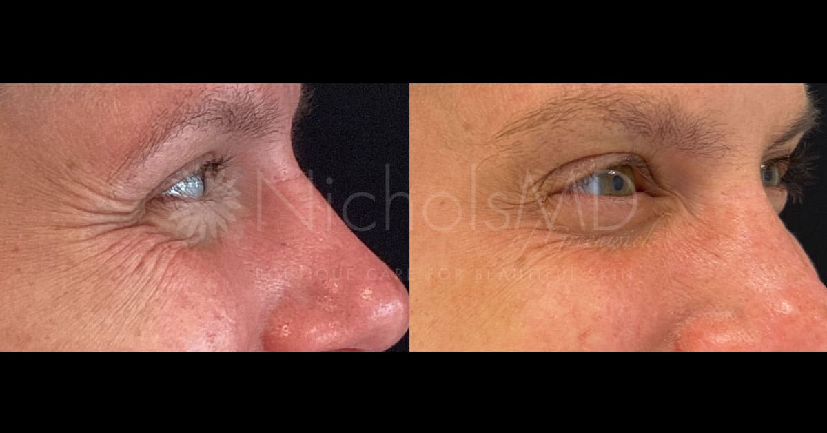 NicholsMD of Greenwich Botox® Eyes Treatment