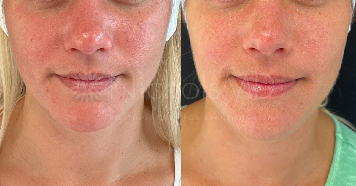 NicholsMD of Greenwich MiniTox Treatment