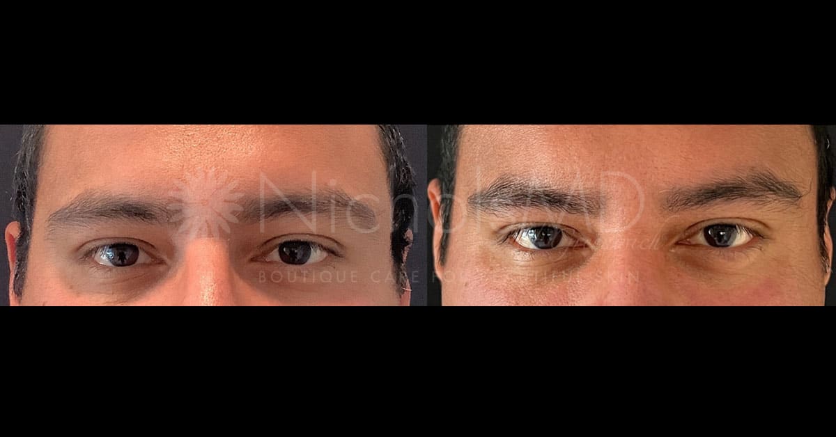 NicholsMD of Greenwich Under-Eye Filler Treatment