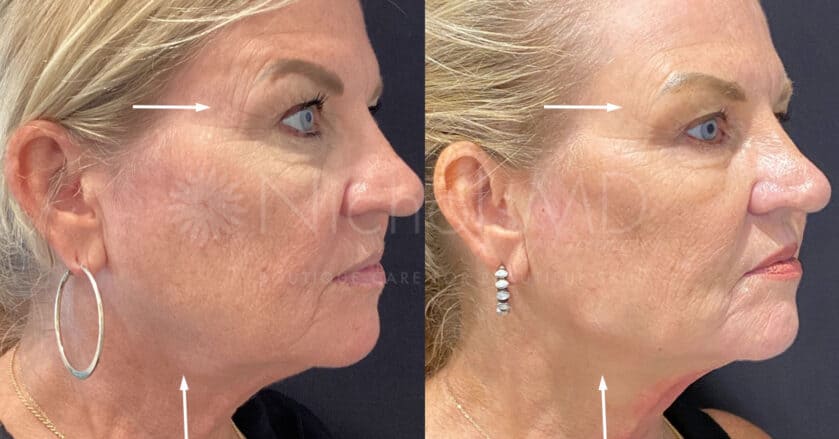 NicholsMD of Greenwich Full Face Rejuvenation with PRF Treatment