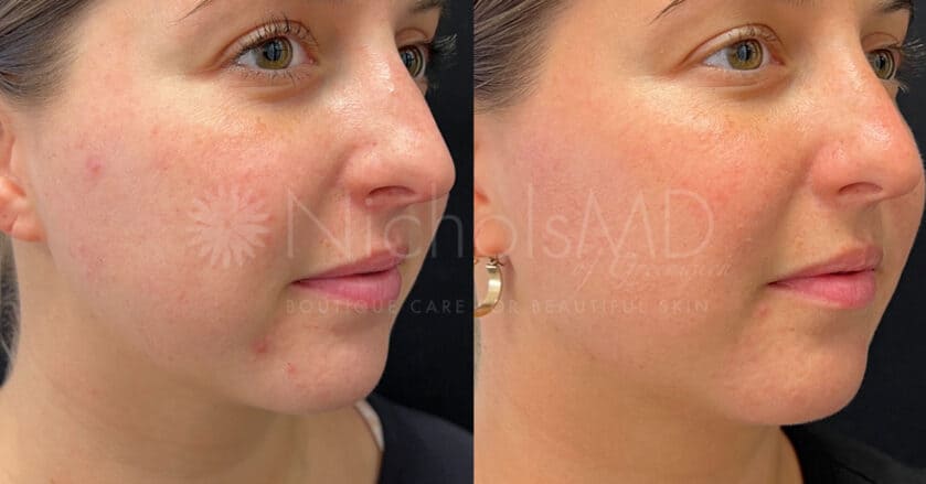 NicholsMD of Greenwich Microneedling with PRP Treatment