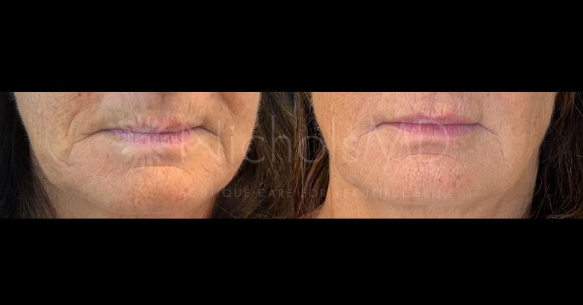 NicholsMD of Greenwich Perioral Lift Treatment