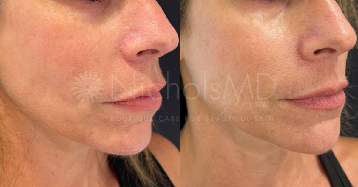NicholsMD of Greenwich GreenwichSecret xSculptra Treatment