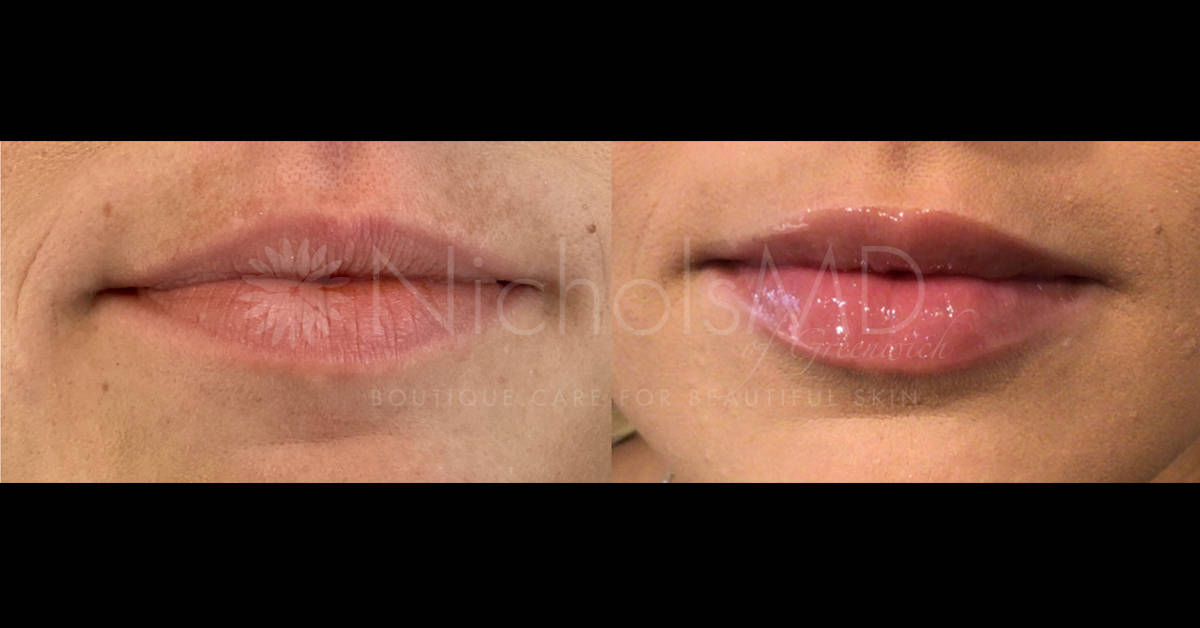 NicholsMD of Greenwich Liquid Lip Lift Treatment
