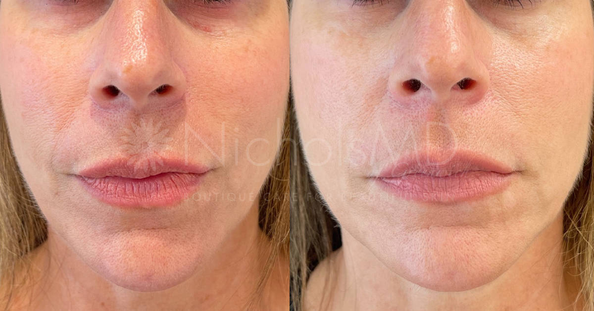 NicholsMD of Greenwich GreenwichSecret xSculptra Treatment