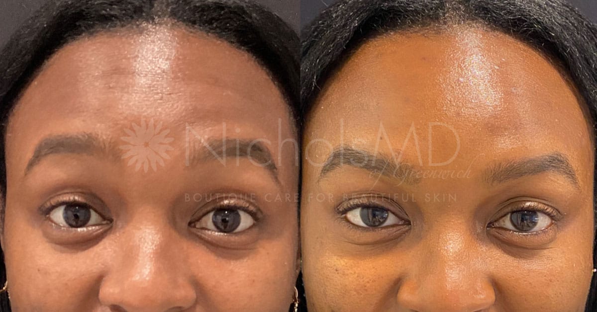 NicholsMD of Greenwich Botox® Treatment