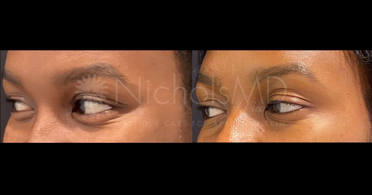 NicholsMD of Greenwich Botox® Treatment