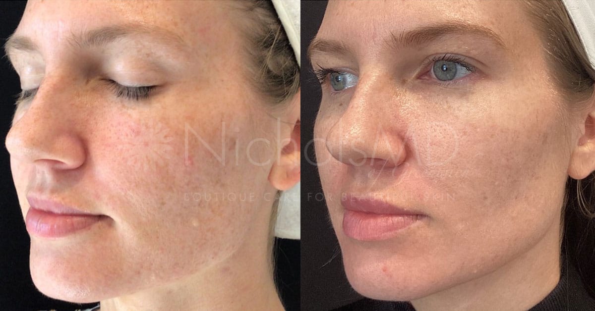 NicholsMD of Greenwich AviClear Treatment