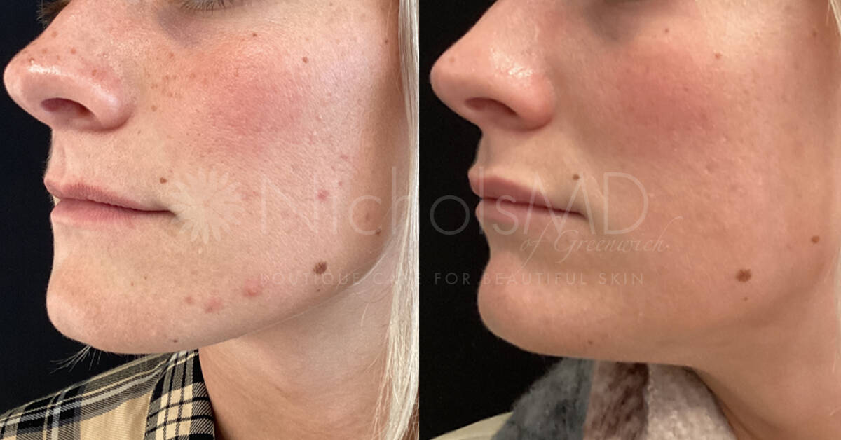 NicholsMD of Greenwich AviClear Treatment