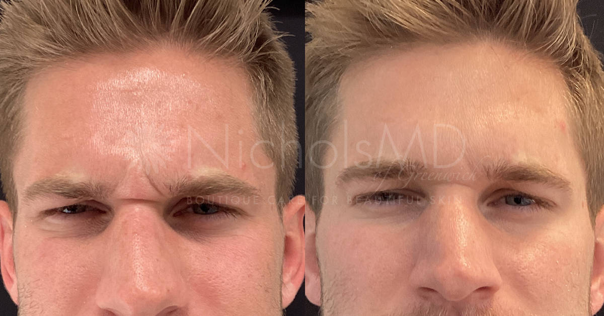 NicholsMD of Greenwich Botox® Treatment