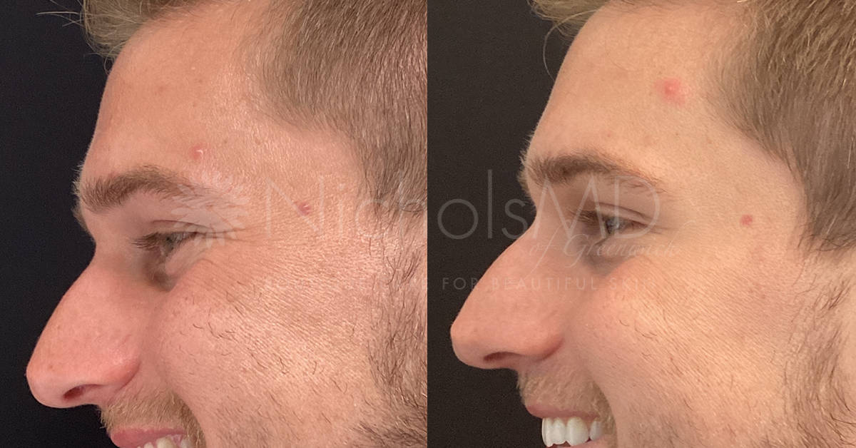 NicholsMD of Greenwich Botox® Treatment