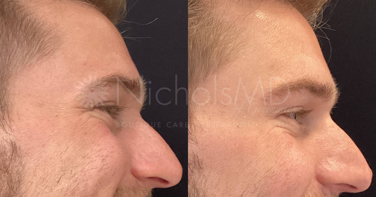 NicholsMD of Greenwich Botox® Treatment