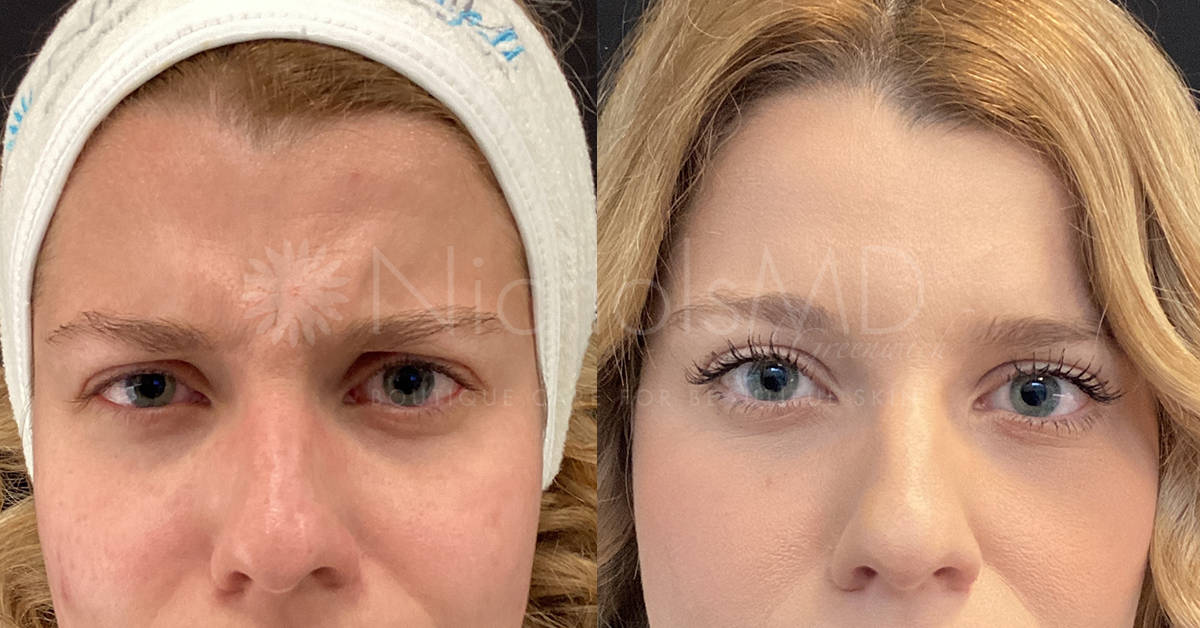 NicholsMD of Greenwich Botox® Treatment