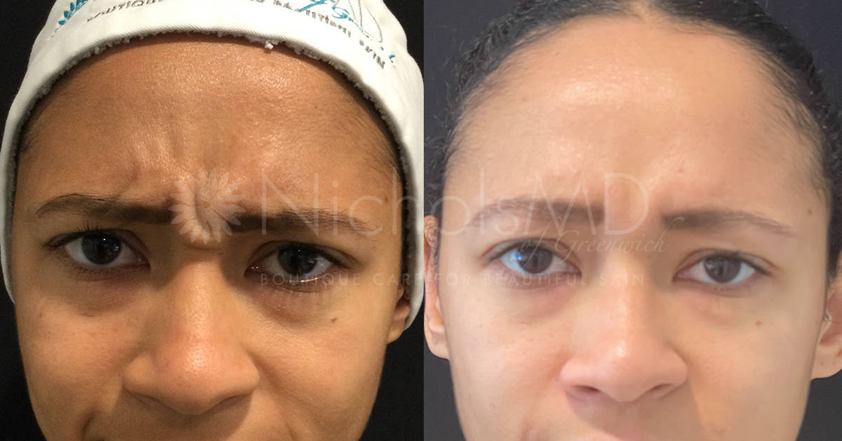 NicholsMD of Greenwich Botox® Treatment