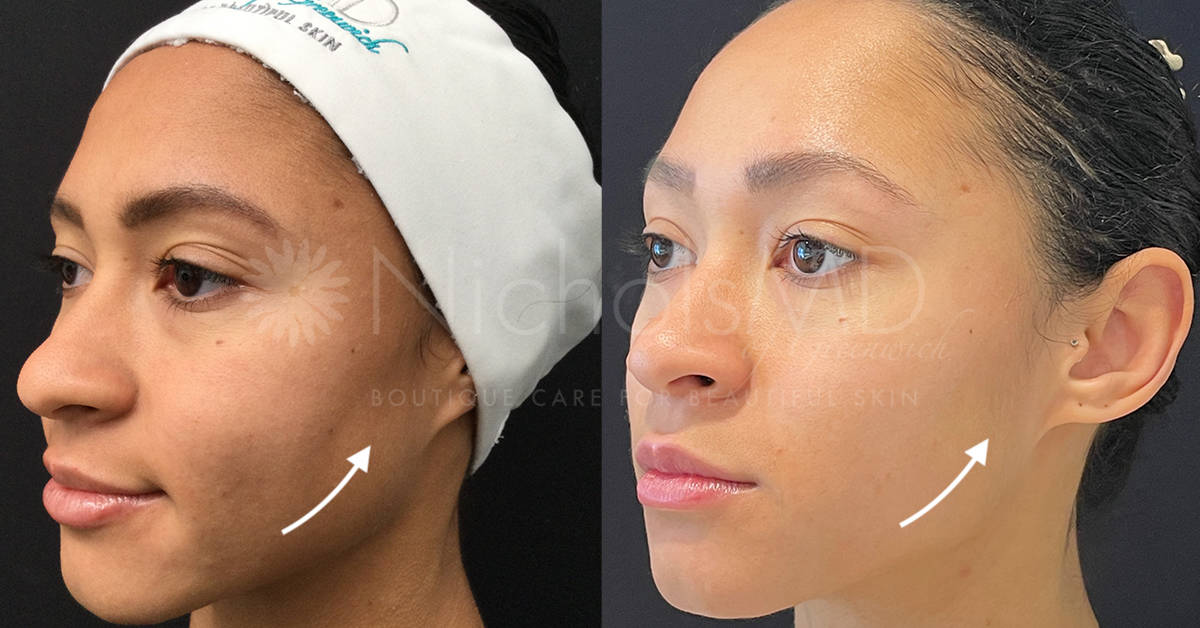 NicholsMD of Greenwich Facial Rejuvenation with Sculptra Treatment