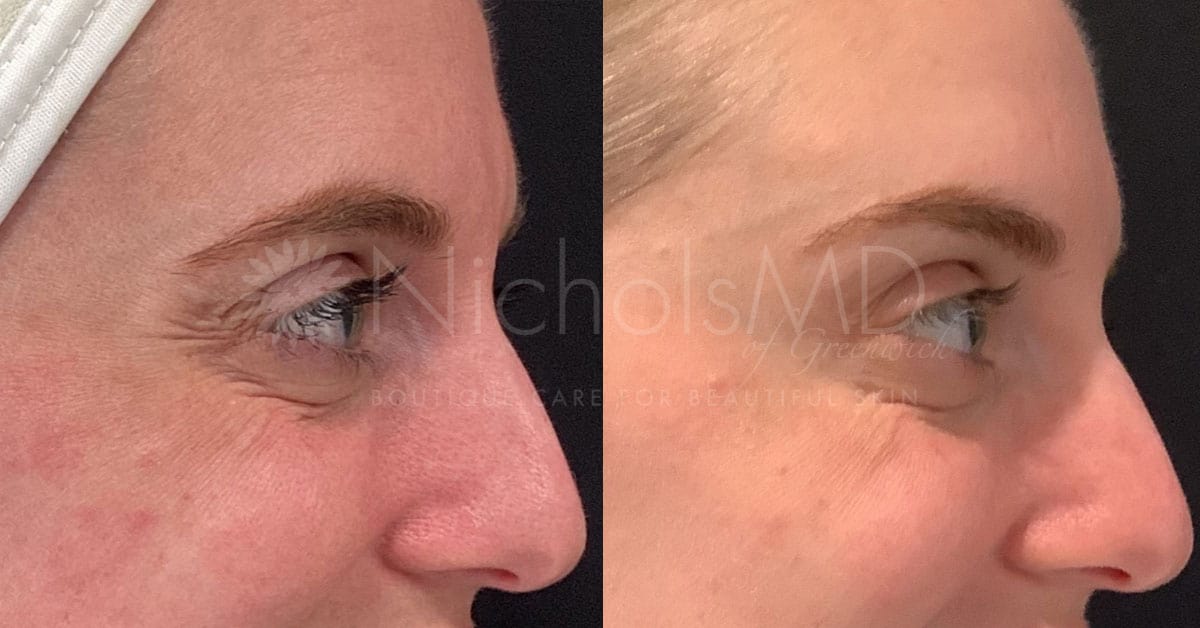 NicholsMD of Greenwich Botox® Treatment