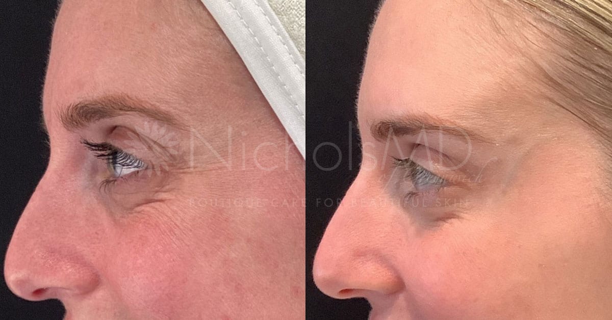 NicholsMD of Greenwich Botox® Treatment