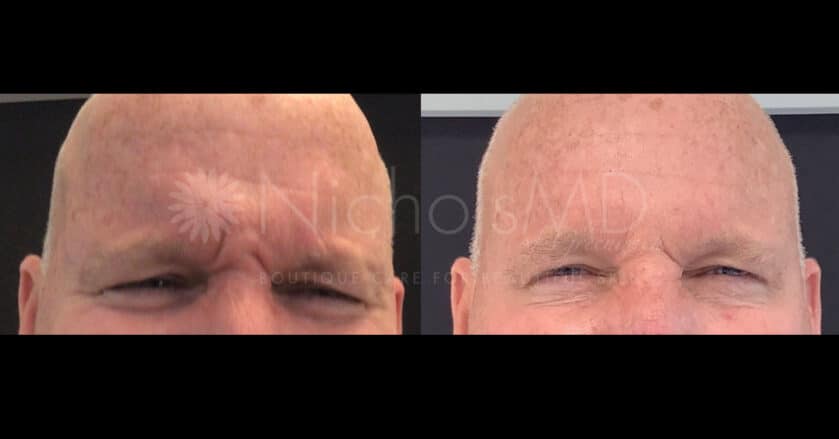 NicholsMD of Greenwich Botox® Treatment