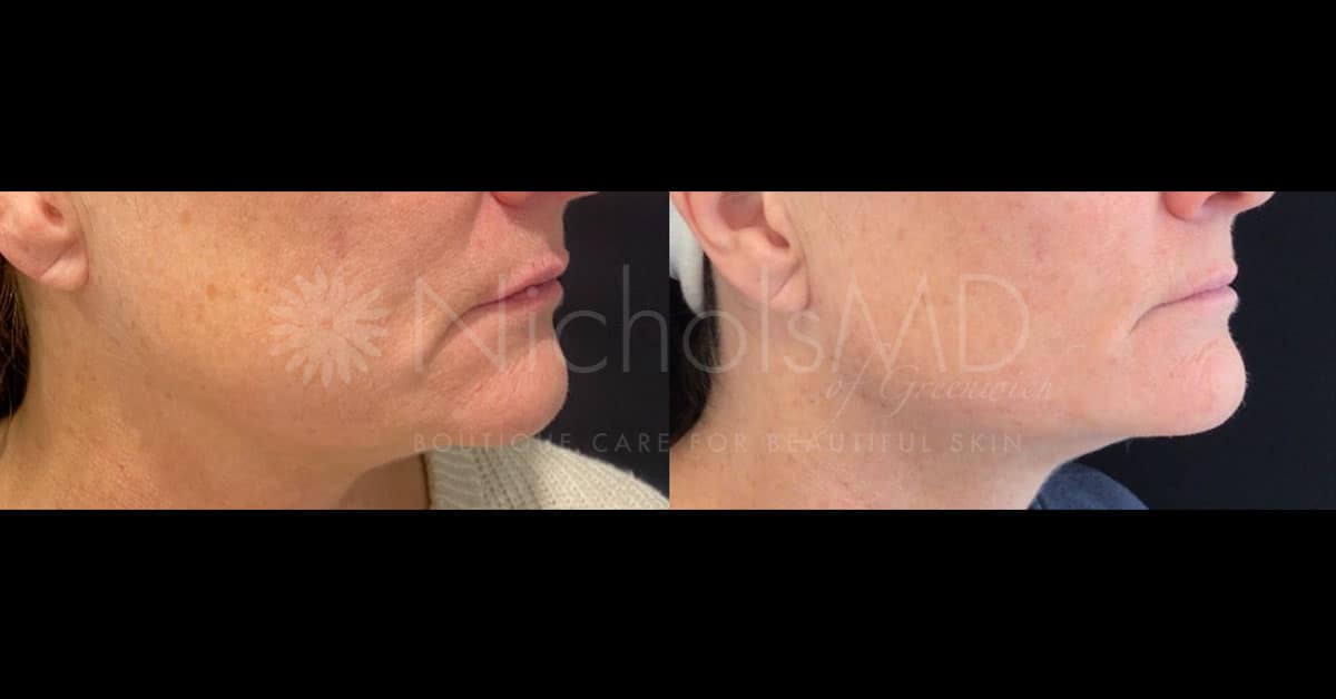 NicholsMD of Greenwich Jawline with Volux Treatment