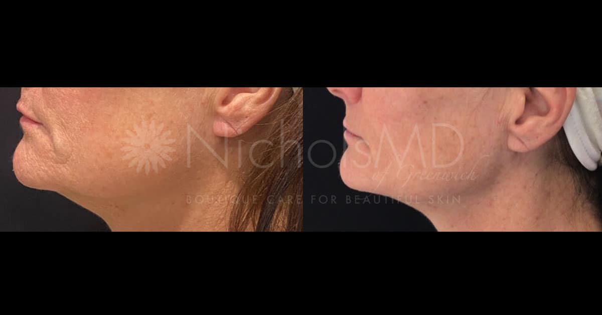 NicholsMD of Greenwich Jawline with Volux Treatment
