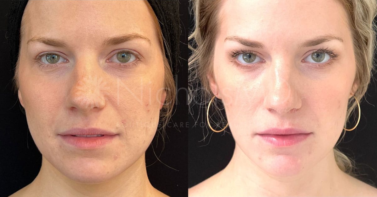 NicholsMD of Greenwich Masseters Treatment